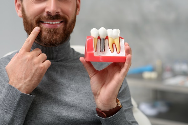 Dental Implants: Replacing A Tooth Root